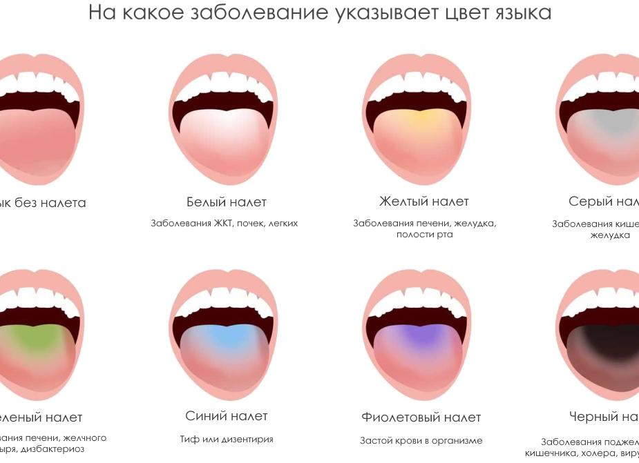 Почему появляется белый налет на языке у взрослых и детей — основные причины