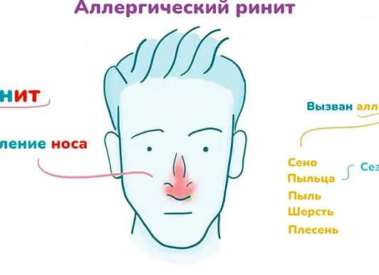 Аллергический ринит – симптомы и лечение у взрослых и детей