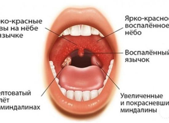 Инфекционный мононуклеоз — пути заражения, симптомы и лечение