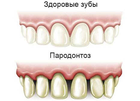 Пародонтоз — лечение в домашних условиях народными средствами