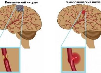 Цереброваскулярная болезнь — причины и первые симптомы, диагностика, методы лечения и профилактика