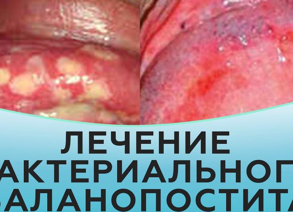 Причины баланопостита у мужчин — симптомы, диагностика, методы лечения