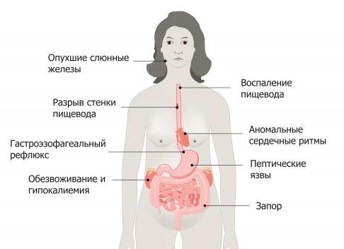 Симптомы и лечение булимии