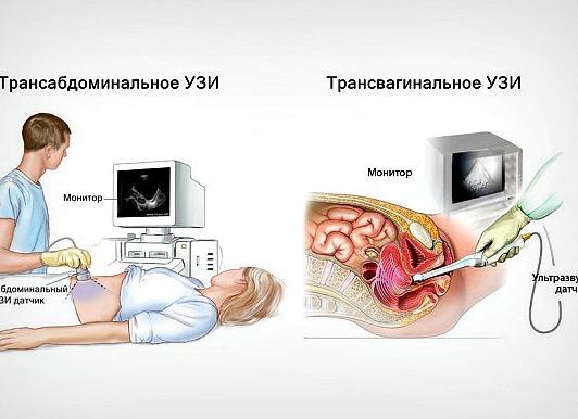 УЗИ для определения беременности: срок в неделях