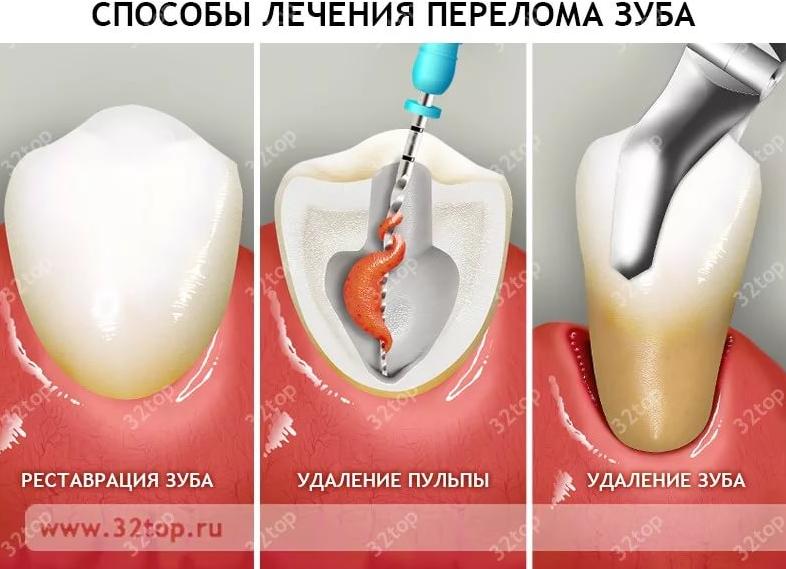 Что делать, если сломался зуб, а корень остался в десне — какие принимать меры?