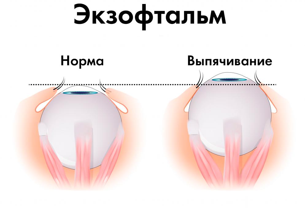 Экзофтальм — причины, симптомы и лечение