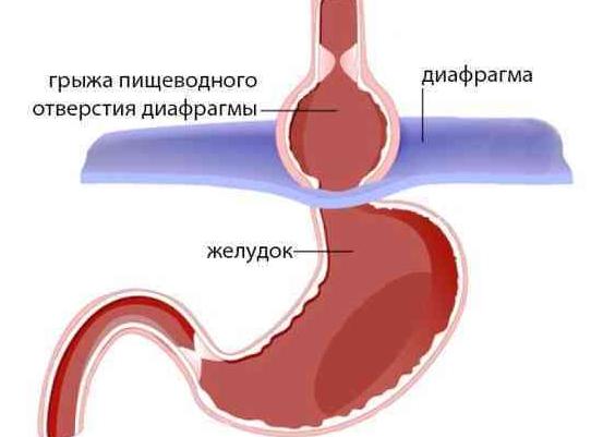 Грыжа желудка: патогенез, проявления и тактика лечения