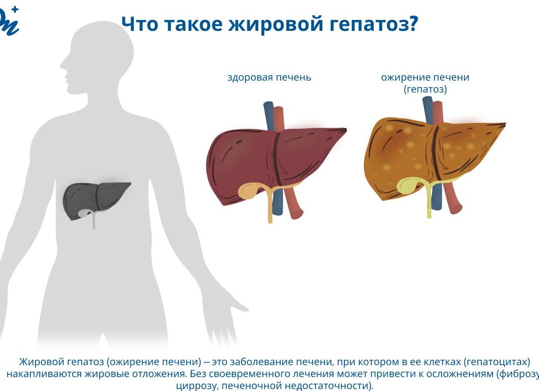 Как лечить жировой гепатоз печени бабушкиными средствами и лекарствами