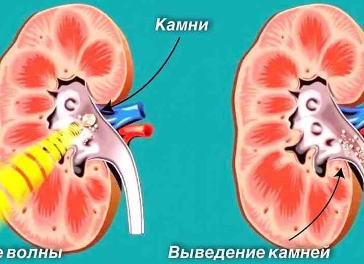 Литотрипсия – эффективная процедура дробления камней в мочеточнике