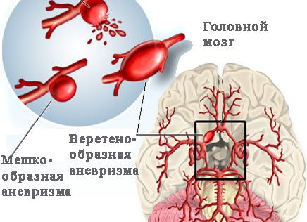 Что такое аневризма сосудов головного мозга и каковы последствия ее разрыва