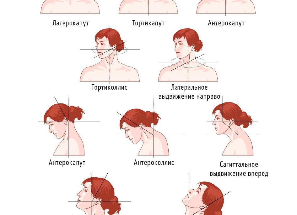 Что такое спастическая кривошея и как от нее избавиться?