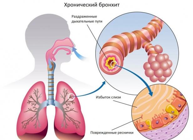 Хронический бронхит– симптомы и лечение у взрослых в домашних условиях
