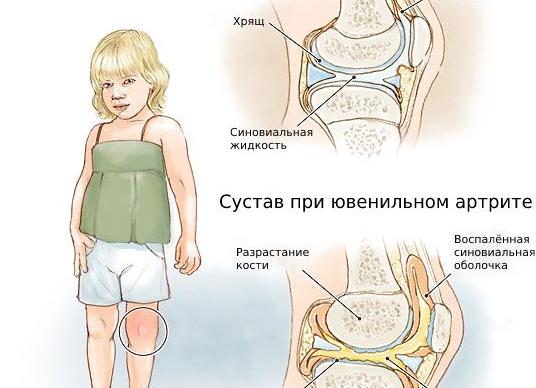 Ревматоидный артрит у детей