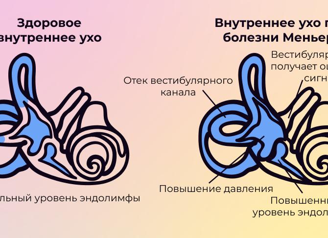 Болезнь Меньера – причины возникновения, признаки, проявления у детей и взрослых