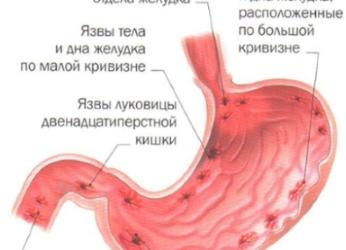 Язва желудка — симптомы