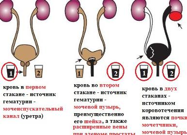 Кровь в моче у женщины: причины