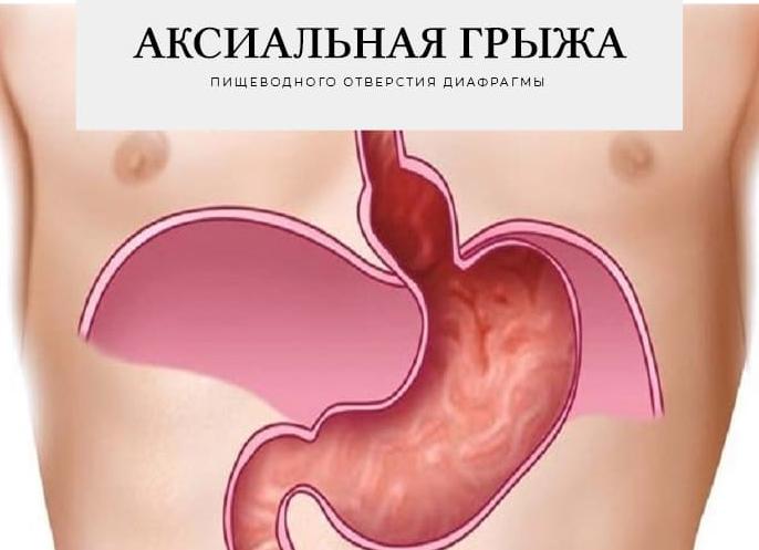 Лечение аксиальной грыжи пищеводного отверстия диафрагмы