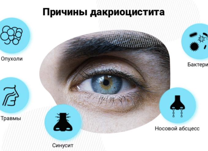 Признаки дакриоцистита у детей и взрослых — симптомы и дагностика