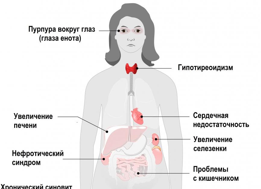 Амилоидоз почек — причины возникновения, симптомы, диагностика и лечение