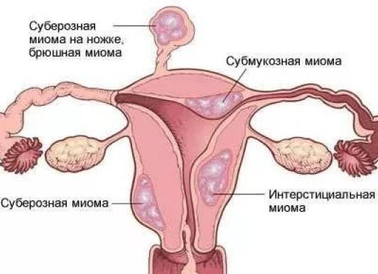 Интерстициальный миоматозный узел