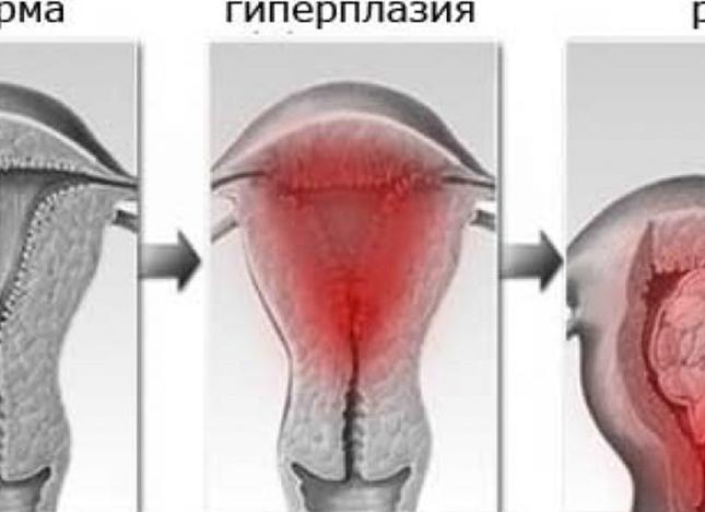 Патология эндометрия в постменопаузе