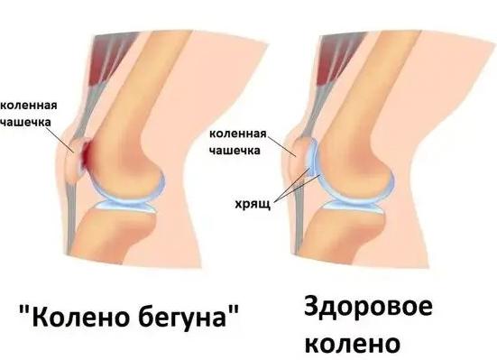 Почему болит чашечка колена при сгибании или в покое?