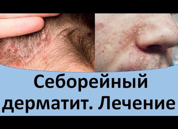 Себорейный дерматит на лице – лечение болезни кожи