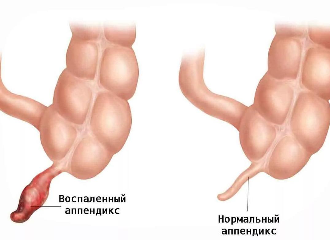 Вся правда про флегмонозную стадию аппендицита