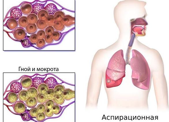 Аспирационная пневмония у детей: симптомы и лечение