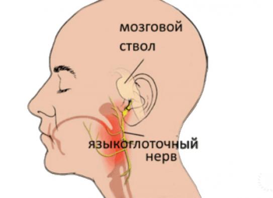Что такое невралгия языкоглоточного нерва: причины, симптомы и лечение