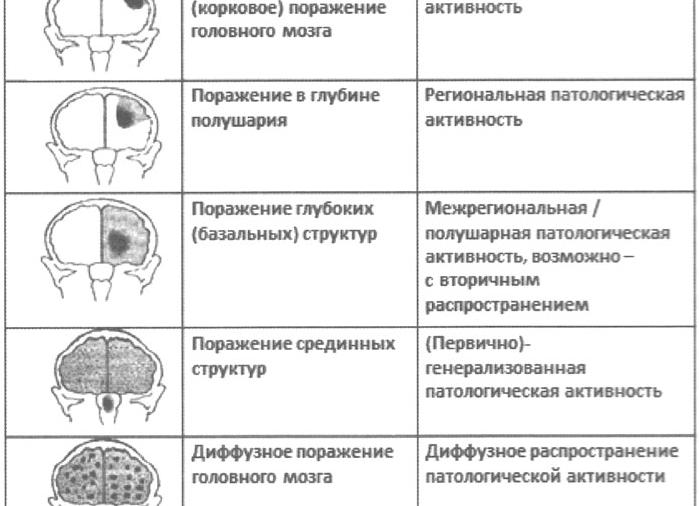 Диффузные изменения биоэлектрической активности головного мозга