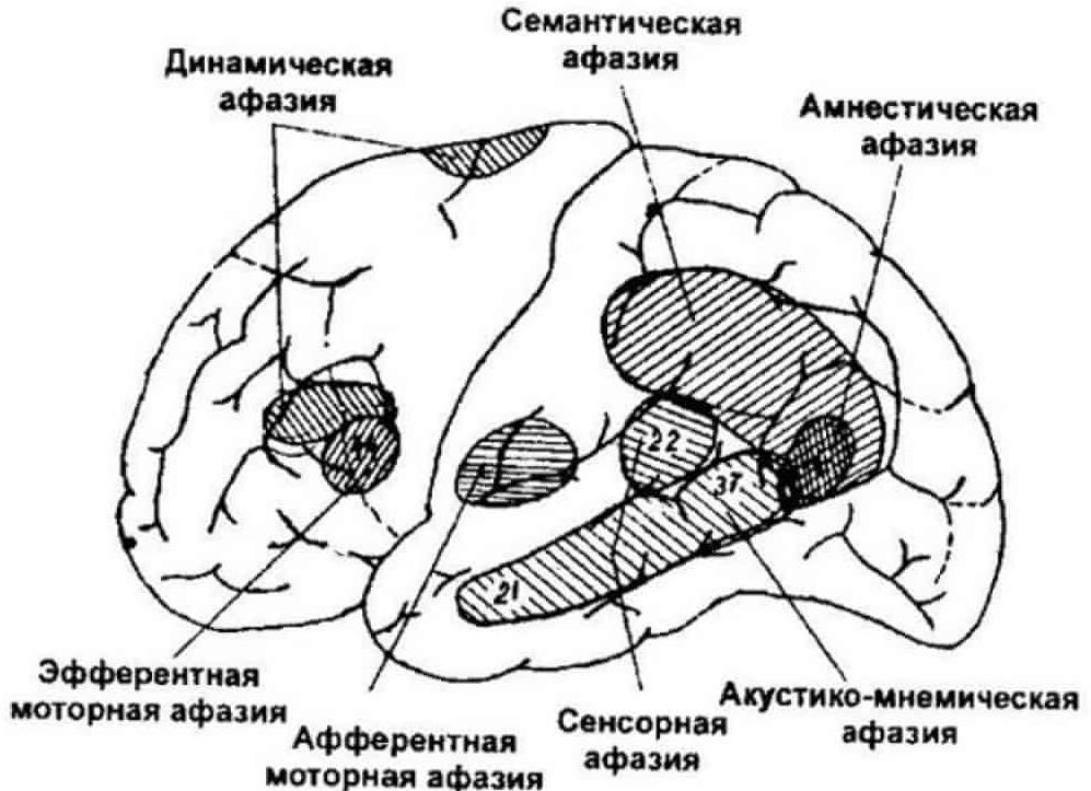 Почему возникает амнестическая афазия и как она проявляется