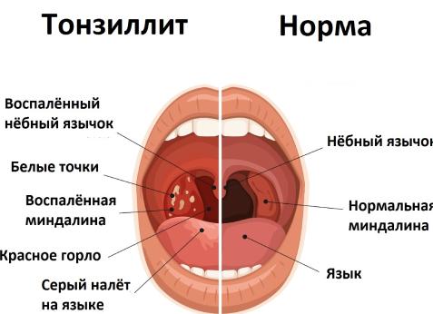 Чем лечить ангину у детей и взрослых в домашних условиях — эффективные медикаментозные и народные средства