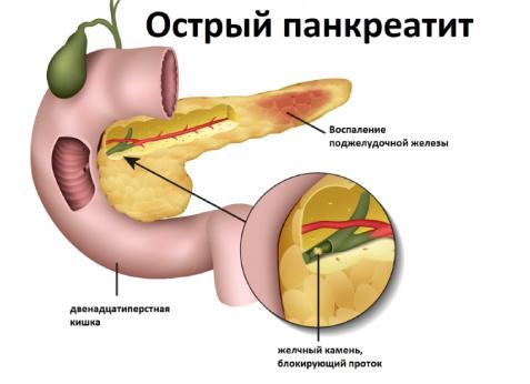 Геморроидальное кровотечение – симптомы и признаки осложнений