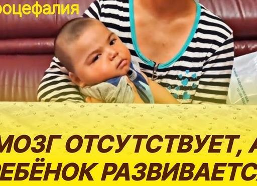 Микроцефалия: тело растет, а мозг и голова — нет