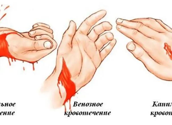 Паренхиматозное кровотечение: признаки и первая помощь для остановки
