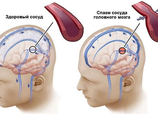 Спазм сосудов головного мозга: причины, симптомы и лечение