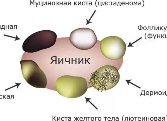 Цистаденома яичника — причины, симптомы и виды заболевания, методы лечения и профилактика