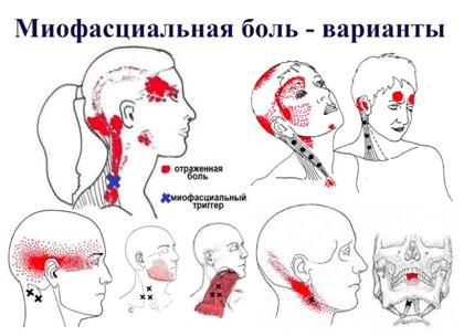 Лечение и симптомы вертеброгенной цервикокраниалгии на фоне шейного остеохондроза
