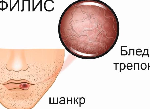 Лечение сифилиса в домашних условиях — схемы приема препаратов и терапия народными средствами