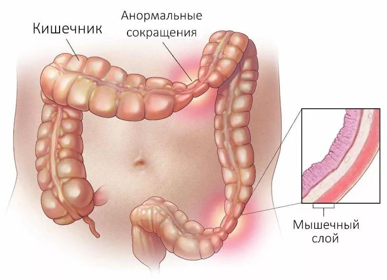 Особенности и важность лечения синдрома раздраженного кишечника