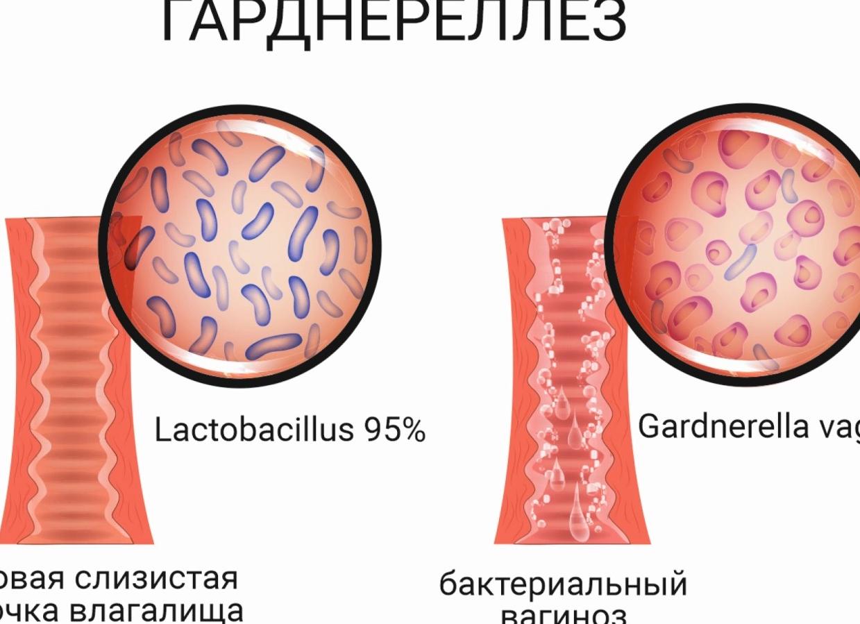 Причины возникновения гарднереллеза у женщин — пути заражения