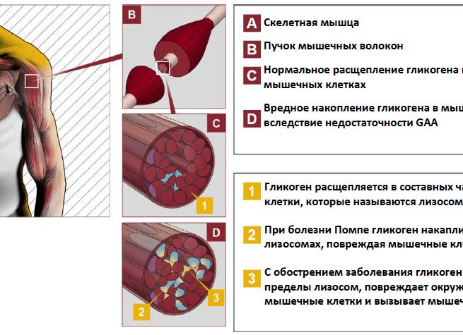 Болезнь Помпе у детей и взрослых
