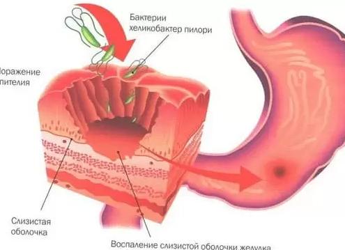 Эрозивно-язвенный бульбит 12-перстной кишки