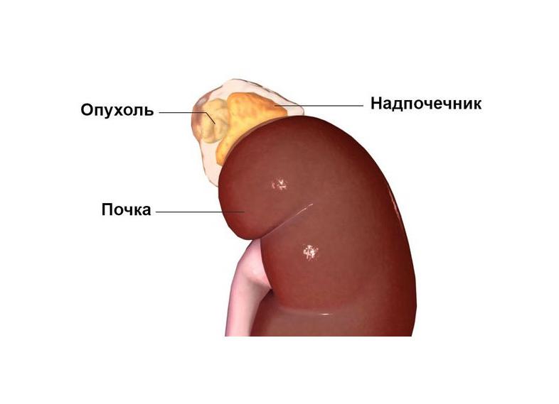 Первичный гиперальдостеронизм: симптомы и лечение