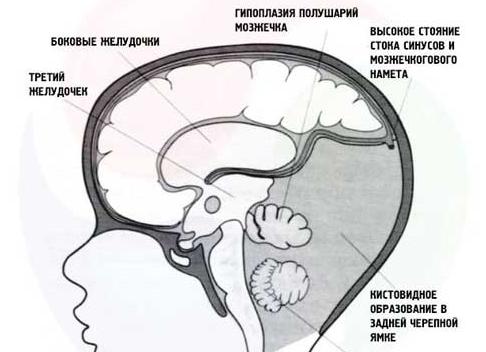 Синдром Дэнди-Уокера — тяжелая врожденная аномалия мозга