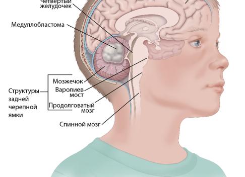 Дислокация головного мозга: причины, лечение и последствия