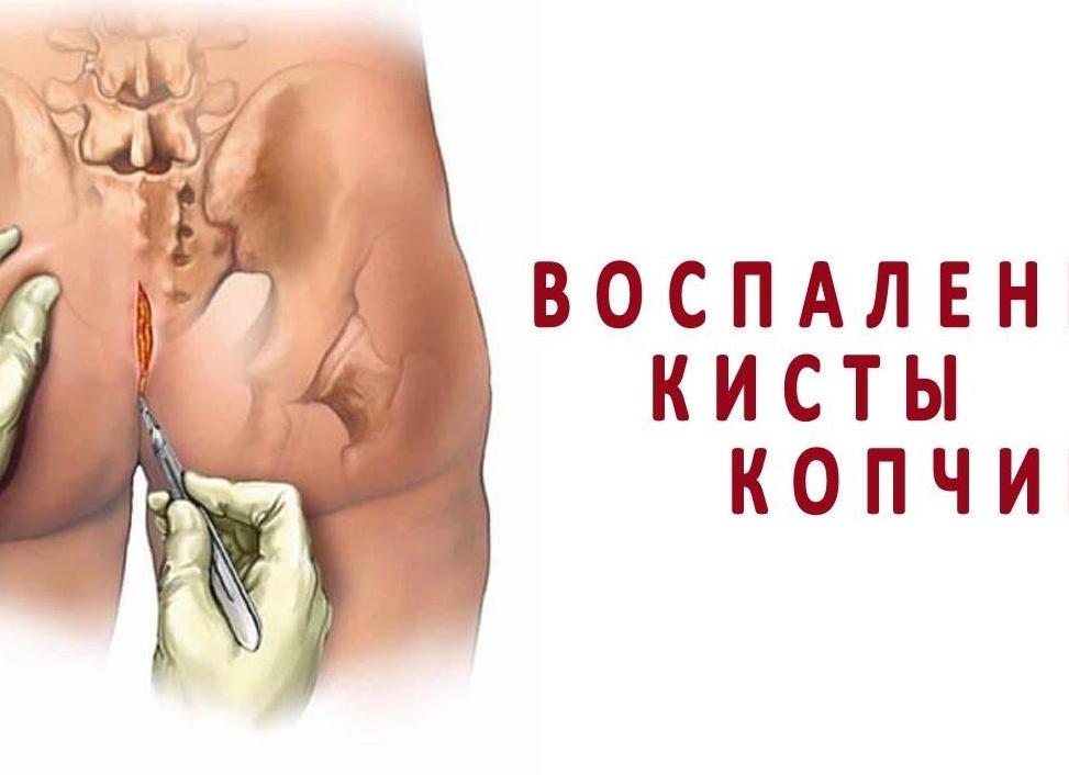 Киста копчика — причины возникновения, симптомы, диагностика, медикаментозное и оперативное лечение