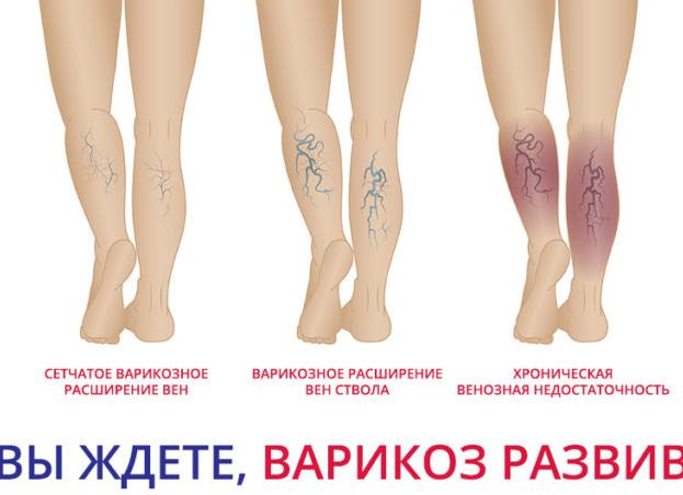 Сосуды на ногах болят