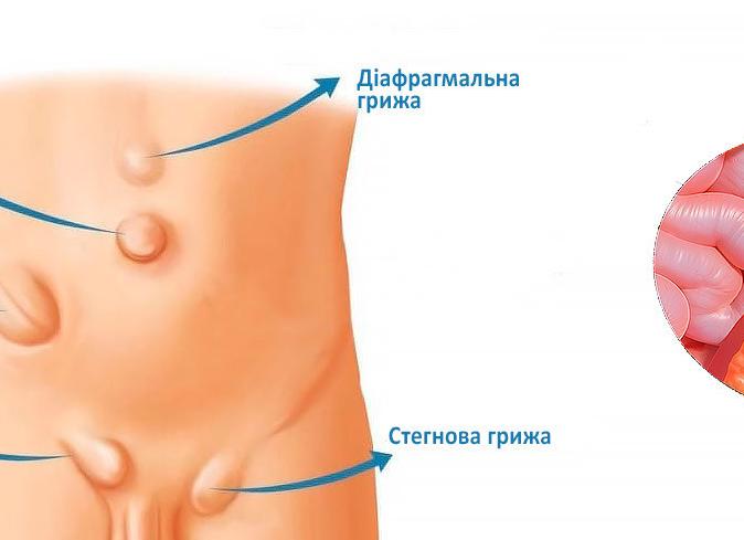 Грыжа желудка — причины возникновения, виды, симптомы, диагностика, консервативное и хирургическое лечение